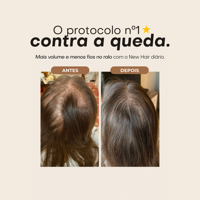Protocolo de tratamento NHV Ácido Hialurônico